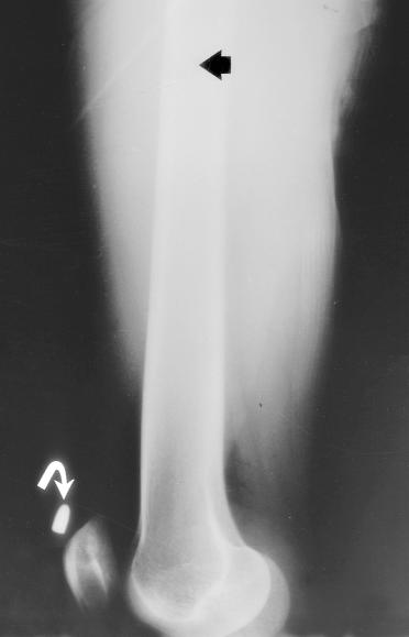 Figure 8. Low-velocity bullet ijury to the thigh.