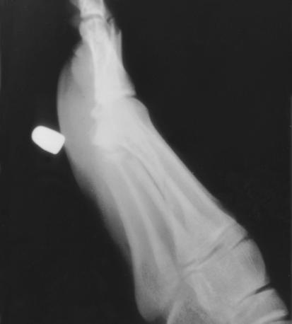 third metatarsal fracture superior ad posterior to the bullet.