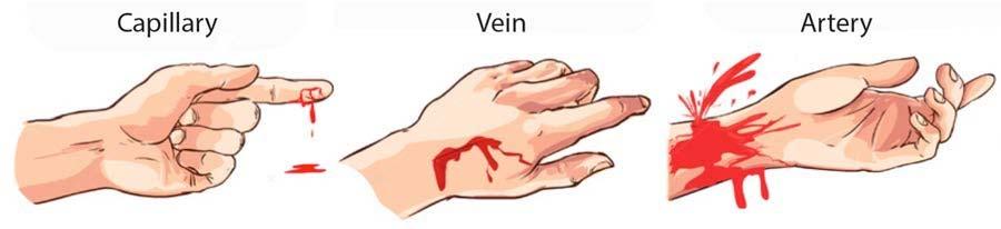 Control Bleeding Three Bleeding Types Capillary Bleeding Indicators: 1. Slow, Even Flow Venous Bleeding Indicators: 1. Steady, Dark Flow 2.