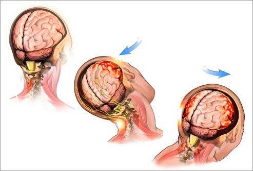 WHAT IS A CONCUSSION A concussion is a traumatic brain injury caused by a bump, blow, or
