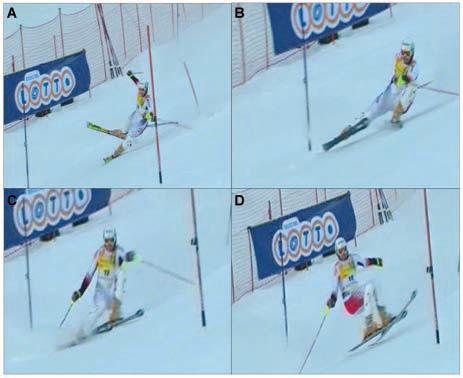 Kinematics of Anterior Cruciate Ligament Ruptures in World Cup Alpine Skiing The main mechanism, termed the slip-catch mechanism, is characterized by a pattern in which the skier is out of balance