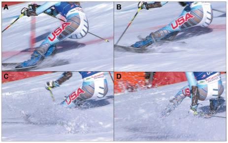 Case 2: slip-catch situation (anterior cruciate ligament injury to the left knee) (A) At 300 milliseconds, the skier is out of balance backward and inward in a right-hand turn.