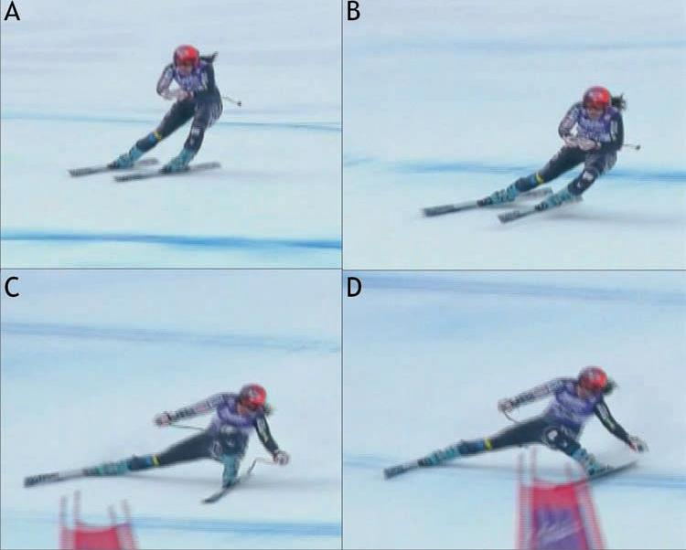Events leading to dynamic snowplow mechanism (ACL injury to the left knee) A. The racer initiates a left hand turn too early with too inside lean B.