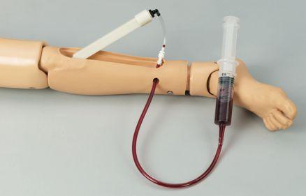 Proper needle insertion and pressure applied to the syringe will allow blood to flow through the tubing and fill the bone. (See figure 13.) 8.