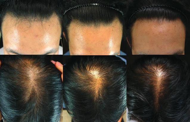 treatment and after dutasteride treatment Baseline Postfinasteride Postdutasteride Hair density (hair counts/cm 2 ) 84 13 87 12* 96 12 Hair thickness (lm) 52 12 53 12 63 11 *P < 0.