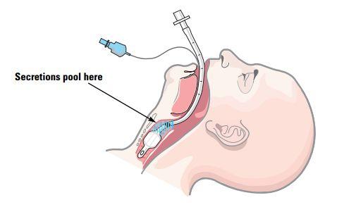 PROCEDURE FOR REPLACING CUFF AIR WITH WATER / NS 1. Prepare both syringes: water & air 2. Suction patient 3. Suction above the cuff 4.