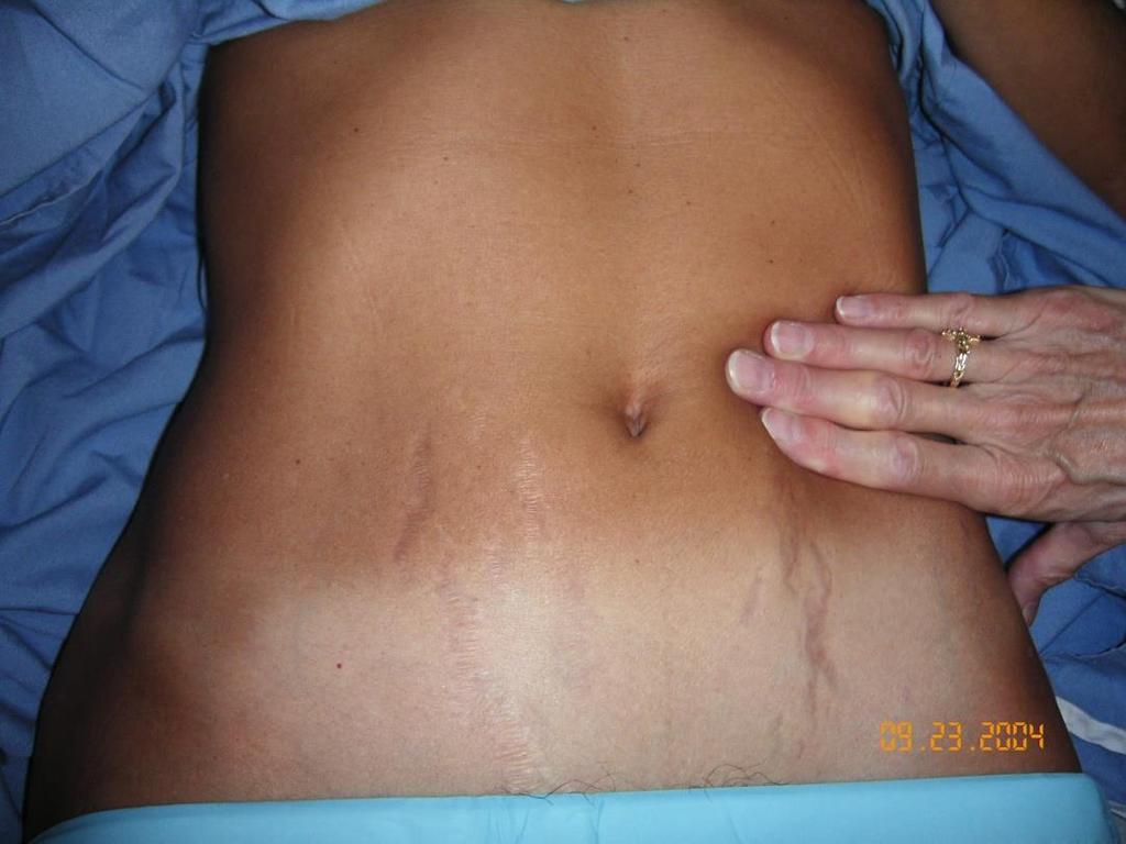 Abdominal Pressure: Non- Specific Posterior At 35-50 cm, or when the tip is