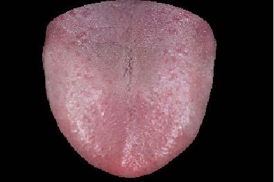 Next, using the threshold method and Otsu s lgorithm for edge segmentation, we removed skin, tooth, lip, background, etc., and then obtained the pure tongue image, as shown in Fig. 3 [4 7].