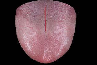 ranging between 56 and 81 years of age (16 males and 14 females), were subjected to the measurements of the tongue image from