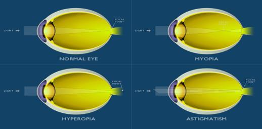 Overview of Ophthalmic Optics Refractive States of the Eye Principles of Vergence (Power) Types of Lenses Sphere, cylinder,
