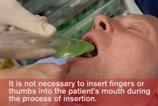 manual for doses Insertion technique Proficient users can insert in < 5 sec Benefits i gel