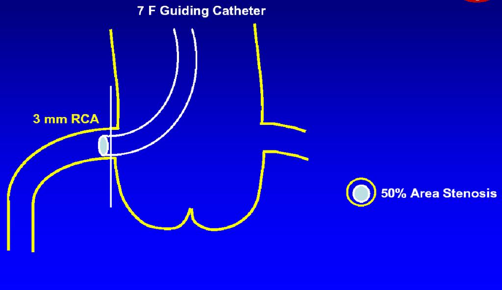Wedging of Guide Catheter 7 Fr Guide Catheter The presence of a guide catheter in the coronary ostium