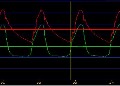 Waveform 1 shows the effect with the catheter inserted and waveform 2 shows the effect
