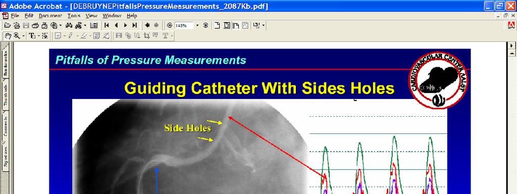 Effect of Using catheter with sideholes Effect of Guide Catheter with Side Holes If a guide catheter