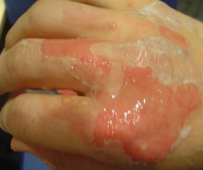 2.9.1 Heat Burns 4. Cover the burn with a sterile, non-stick dressing and loosely bandage in place.