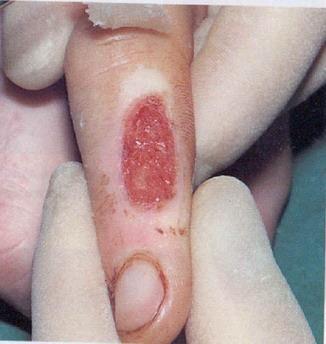 2.9.2 Chemical Burns Chemical burns usually occur when the skin comes in to contact with a strong acid