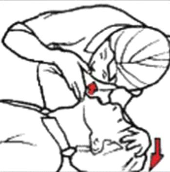 Continue with 30 pumps and two breaths until help arrives If reluctant to give mouth to mouth, continue with chest compressions CPR is needed if