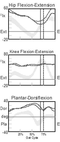 Knee Flexion Impairment issues related to crouch gait tight/spastic hamstrings hip extensor and ankle plantar flexor weakness knee flexion