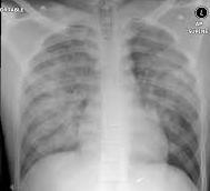Chest x-ray of