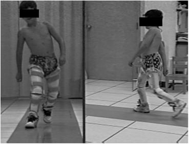 Associated Complex Kinematics Simultaneous motion of Internal pelvis Internal hip Knee flexion (Ounpuu et al, JPO 000) Knee-ankle-foot Orthosis: KAFO Impact of Joint Kinetics Solid ankle Free knee
