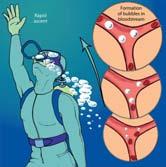 Scuba Diving Emergencies Air embolism Treatment High-concentration O 2 Needle thoracostomy, if tension pneumothorax present Left lateral decubitus position Serial vital signs IV fluids TKO