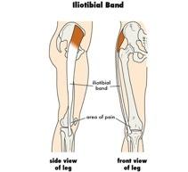 Signs and Symptoms of Runnerʼs Knee: Pain almost exclusively along the outer portion of the knee (the lower part of the the IT band inserts on the lateral tibial condyle) Pain may be worse with