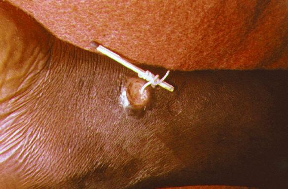 Removal Guinea Worm = Dracunuliasis Burning sensation