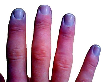 Cyanosis a little orientation to clinical signs If the concentration of deoxygenated Hb is > 50