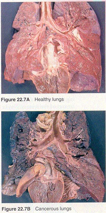 Normal function: Smoking and lung function Mucus and cilia trap and move pollutants and sweep them out of the respiratory system Macrophages kill bacteria Tobacco smoke irritates