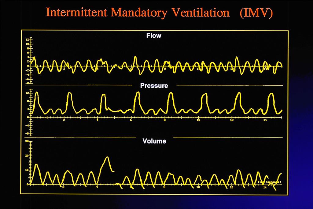Intermi^ent mandatory ven3la3on: IMV/ SIMV Goal:" Support EELV and improve V e in spontaneously breathing infant requiring intubation" Eliminate breath-breath volume variation, cerebral blood flow