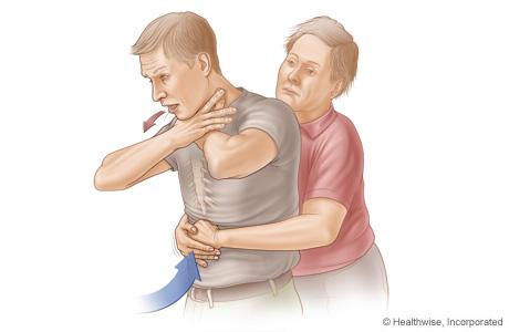Choking Adult and Child Heimlich maneuver for an adult or child older than age 1 A person who is choking cannot talk, cough, or breathe, and may turn blue or dusky.