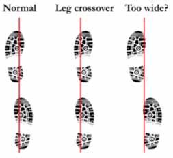 n The painful foot frequently crosses the midline of the body when striking the ground (leg crossover in figure below) Do the following: n Replace worn shoes by selecting shoes with a relatively