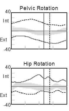 s in CP Internal femoral torsion : Internal Right Hip Rotation Transverse Plane Pelvis & Hip : increased