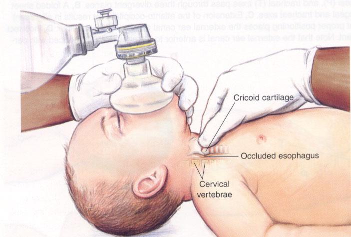 setting, preferentially ventilate & oxygenate infants & children