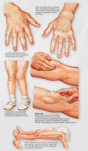 Juvenile Rheumatoid Arthritis (JRA) Rash is salmon colored with central clearing (different than Lyme) Systemic (20%) Polyarticular (50%) Pauciarticular (30%) Girls