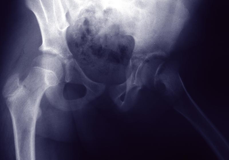 Slipped Capital Femoral Epiphysis Unstable: Patient is
