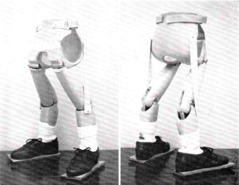 37 Fig. 8. Swivel walker equipped with articulated limbs to permit sitting, and fabricated to improve cosmesis.