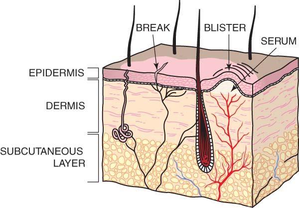 FIGURE 2-1 First-degree burn only the skin surface