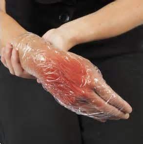 Burns A burn is a skin injury caused by heat, electricity, chemicals, friction or radiation.