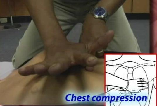 Chest Compressions