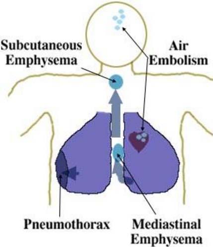 Air Embolism Occurs within 2-3 minutes Cardiac arrest or arrhythmias