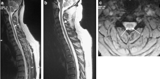 Spinal Cord Bends