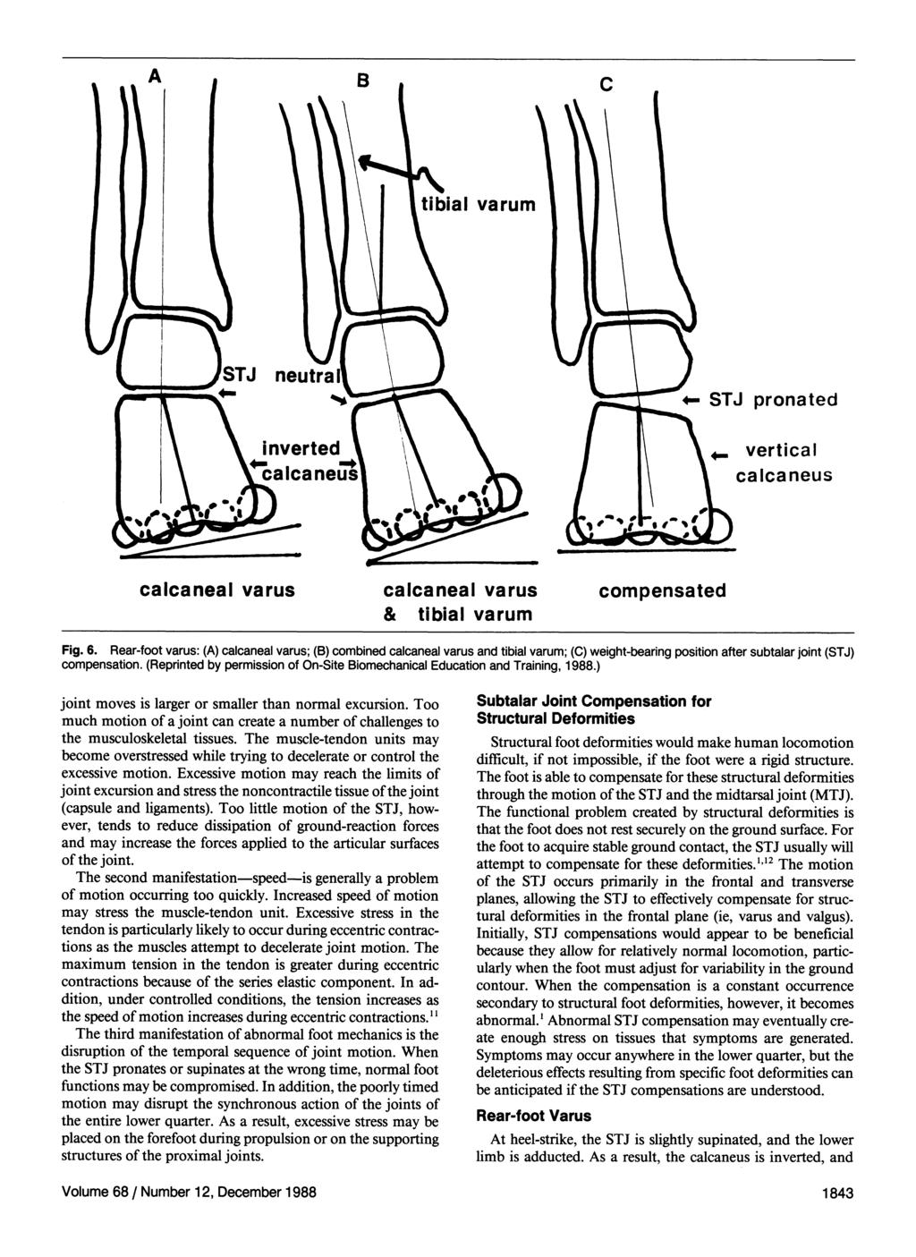 Fig. 6. Rear-foot varus: (A) calcaneal varus; (B) combined calcaneal varus and tibial varum; (C) weight-bearing position after subtalar joint (STJ) compensation.