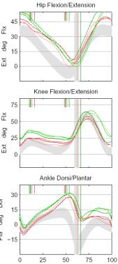 Left Right Hip extension 10 (contracture) 10 (contracture) Anteversion 50 35 Tibial torsion (BM) 0