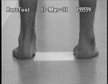 3 point pressure system for talipes varus 3 point pressure system for talipes valgus In children with neuromuscular disorders, pes valgus is the 2nd most common foot deformity Equinus is the most