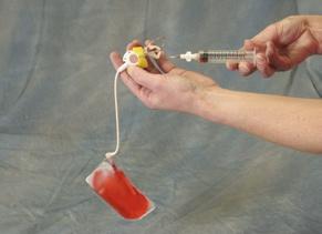 all the way in, attach the syringe to the Huber needle extension set and access the port. Holding the accessed port in one hand, allow the bag to hang below, as shown in Photo 9.