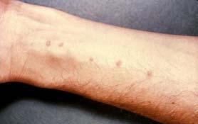 Schistosome dermatitis, or swimmers itch occurs when