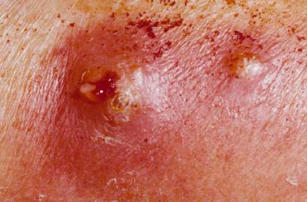 Common Skin Disorders in Wrestling Methecillin Resistant