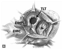 30 của kỹ thuật tạo đường hầm trong tâm thất là nhằm đưa dòng máu từ tâm thất trái lên ĐMC và tạo vách ngăn giữa tuần hoàn hệ thống và tuần hoàn phổi.
