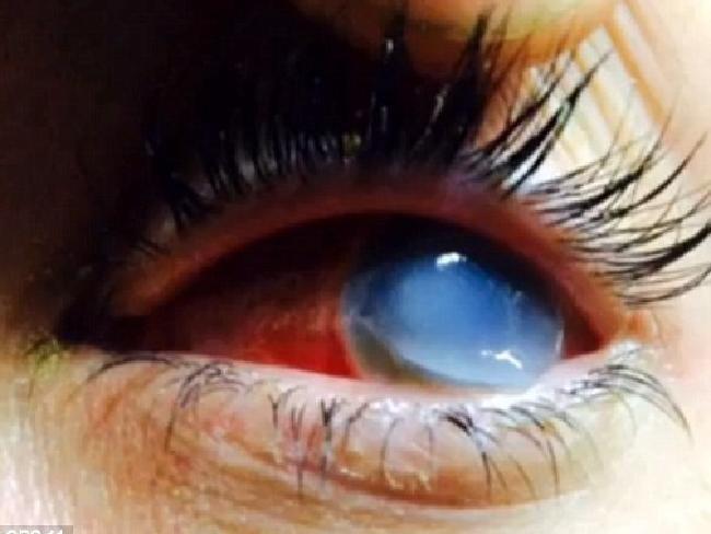Blindness caused by contaminated mud at mud run In 2015 mud debris resulted in bacteria destroying the cornea of a woman s eye, sending the woman blind